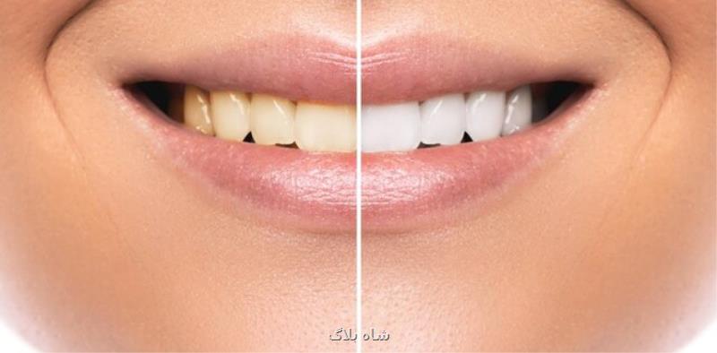 تأثیر مخرب محصولات سفید کننده بر دندان ها