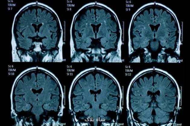 پیری زودرس مغز نوجوانان به دنبال قرنطینه کووید-۱۹