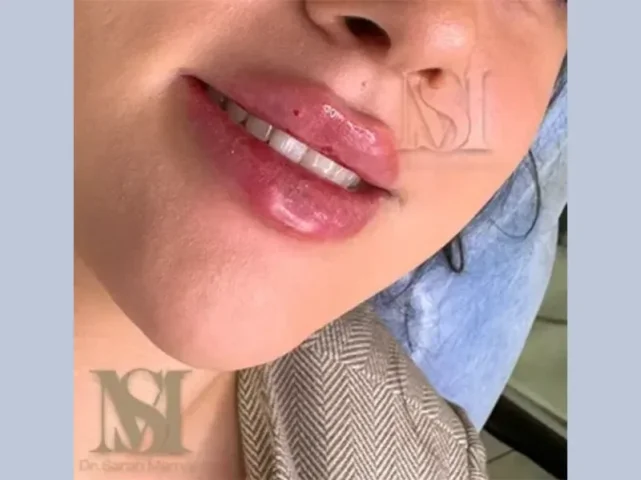 استفاده از فیلر لب چه تاثیری در زیبایی صورت دارد؟