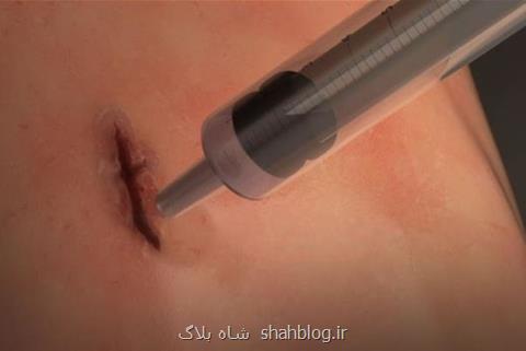 ساخت چسب جراحی یك دقیقه ای توسط محقق ایرانی