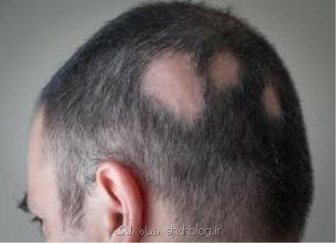 رشد دوباره مو روی پوست لطمه دیده ممكن میگردد
